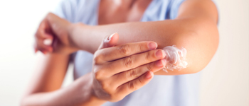 Tip to Manage and Control Summer Eczema Flare-Ups