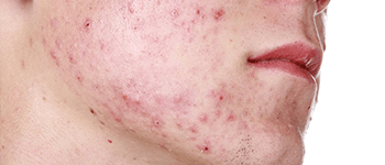 Treatment-for-Acne