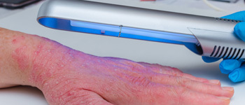 Use Phototherapy to Reduce Eczema