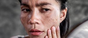 What Causes Melasma?