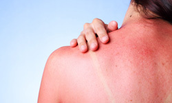 What-Causes-Sunburn