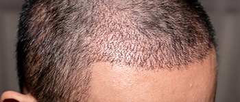 What Happens to Hair Grafts after the Transplant