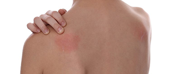 What are the basic facts on Atopic Dermatitis?