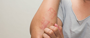 What are the common symptoms of Atopic Dermatitis?