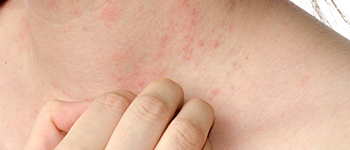 What are the risk factors for Atopic Dermatitis?