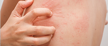 What is Chronic Spontaneous Urticaria or CSU?