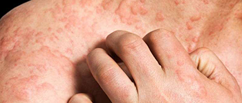 What is the cause of Chronic Spontaneous Urticaria or CSU?