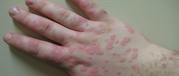 What is urticaria?