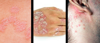 What Are the Symptoms of Psoriasis?