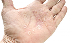 What_is_Psoriasis