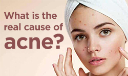 What is the real cause of acne?