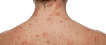 Who is at risk for developing this disease?