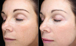 What is fractional laser skin resurfacing?