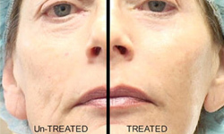 What_stem-cell_facials_do_to_your_skin