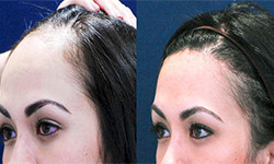How effective is Platelet Rich Plasma for Hair Loss