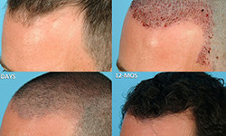 What type of hair transplant is best?