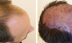 Follicular Unit Transplantation (FUT)