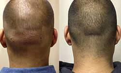 Follicular Unit Extraction (FUE)