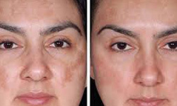 hyperpigmentation-