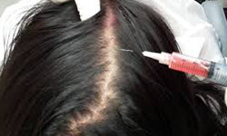 Platelet Rich Plasma for Hair Loss - A Permanent Solution