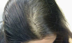 low level laser therapy work to treat hair fall