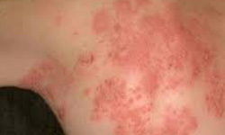 Is Shingles Contagious?