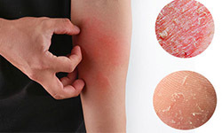 signs and symptoms of atopic dermatitis