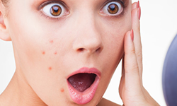 You’ve experienced a sudden increase in acne and untimely breakouts