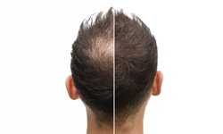 treatment_of_hair_loss