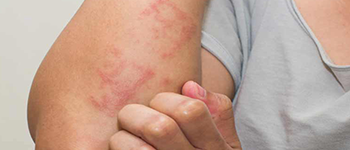 How is urticaria diagnosed and what are the various urticaria treatments available?