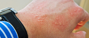 What are the different urticaria types?