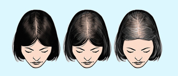 WHAT IS ANDROGENETIC ALOPECIA?