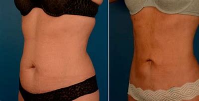 Vaser Liposuction