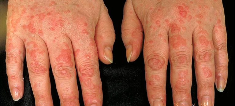 Dr. Sachin Varma Answers FAQ’s on Chronic Spontaneous Urticaria