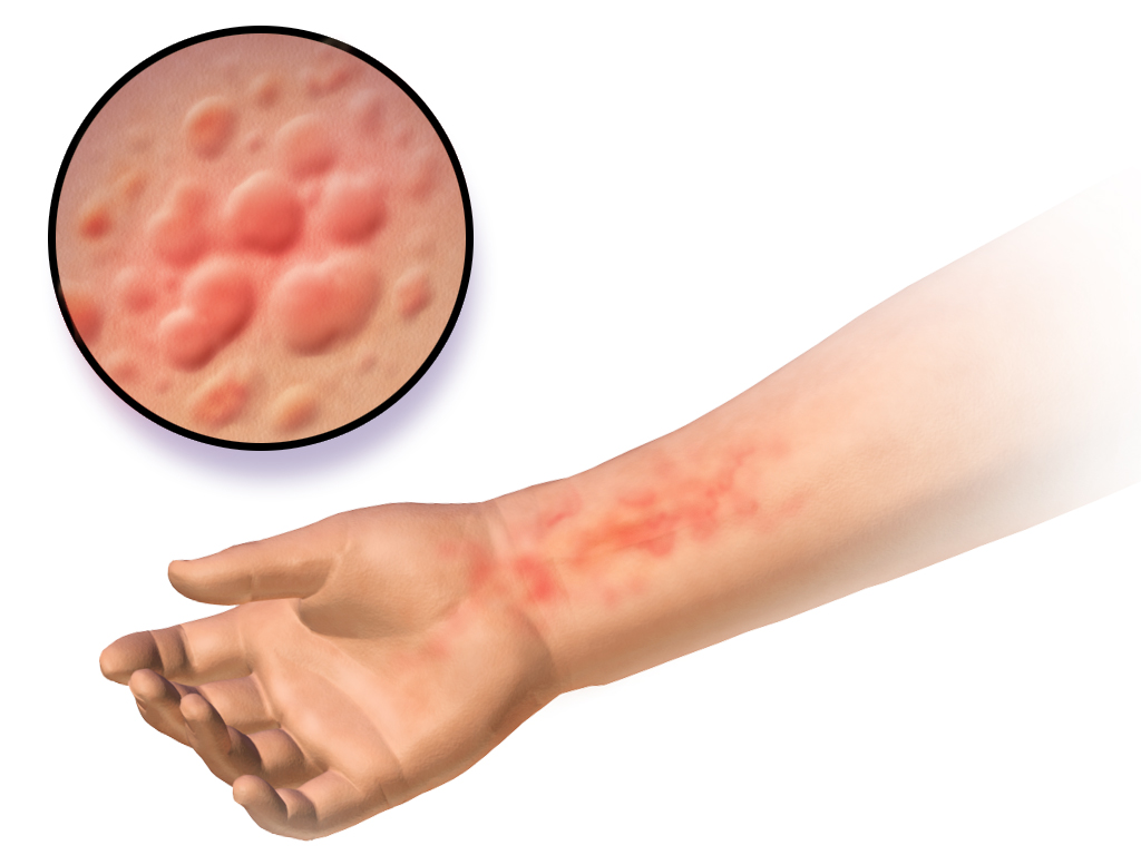 Hives: Symptoms, Causes, and Treatment