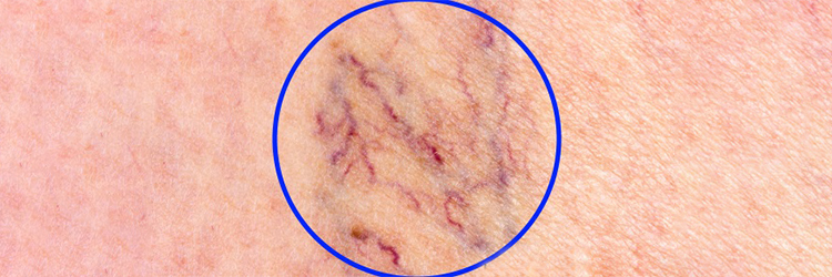 Consult your Dermatologist can help you get rid of those Spider Veins
