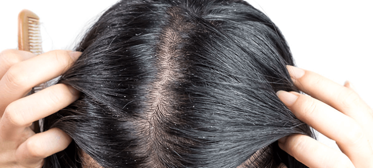 Know about various hair Conditions that are mistaken for Dandruff