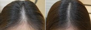 The Science Behind Hair Thinning In Your Early 20s | Skin and Hair Academy