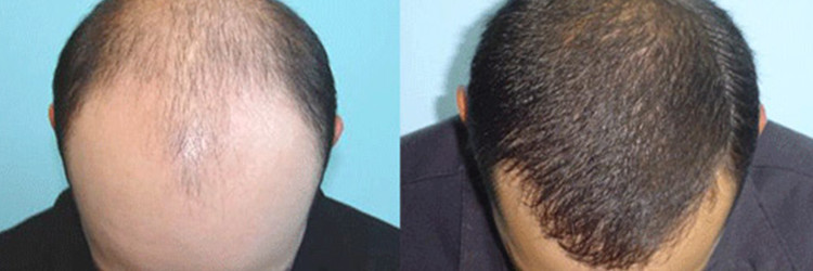 What Type Of Hair Transplant Is Right For You?