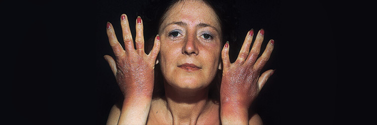 Photosensitivity: Know The Difference Between Photo-Toxicity & Photo-Allergy