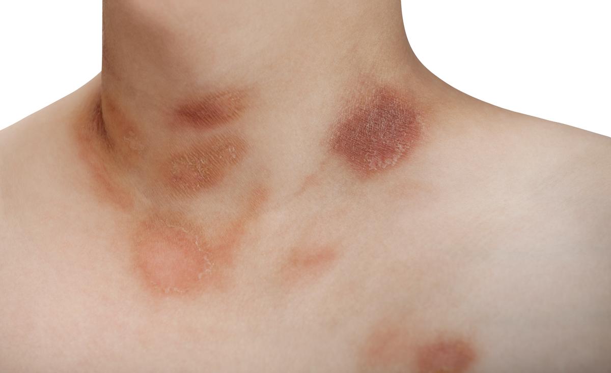 pityriasis rosea skin disease