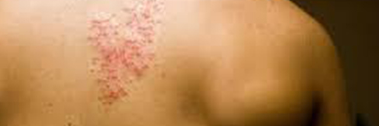 Causes Shingles And How To Treat Them