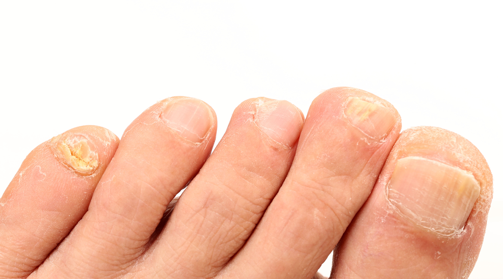 Toenail discoloration: Causes and treatment