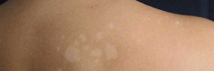 Learn about Sunspots and get rid of them with the help of your dermatologist
