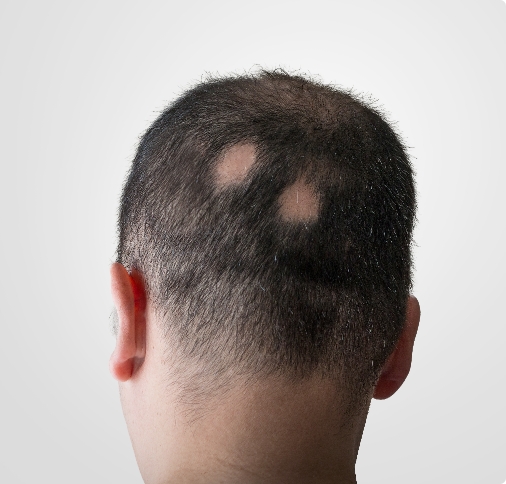 alopecia-qz-img