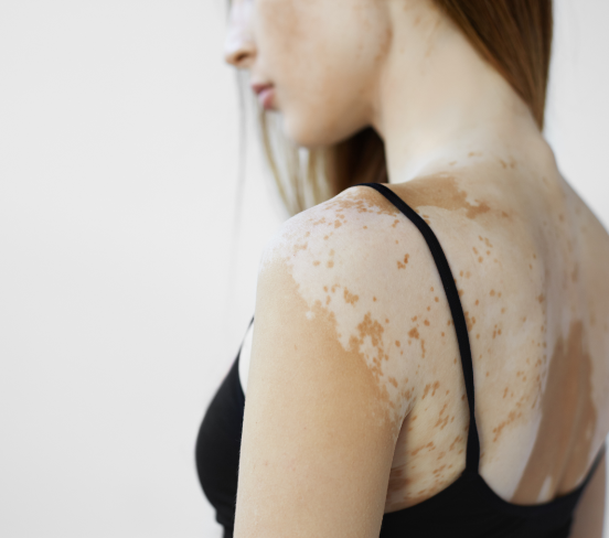 symptoms-vitiligo-01