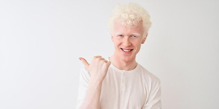 Albinism Disease- Types, Symptoms and Causes