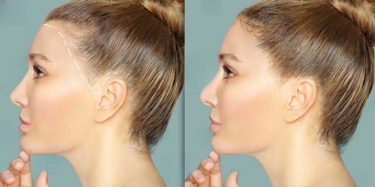 Female Pattern Baldness: Stages, Symptoms, Causes, Treatment
