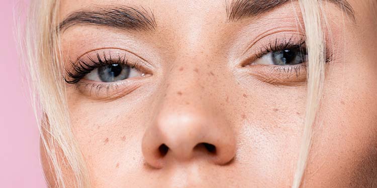 Freckles- Meaning, Causes, Prevention & Treatment
