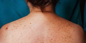 Liver Spots (Age Spots) – Causes, Symptoms, Treatment & Prevention